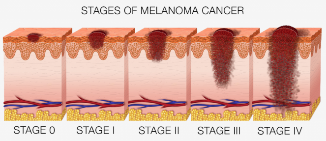 melanoma stages