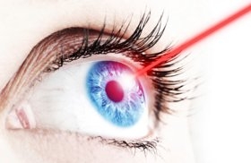 laser eye surgery