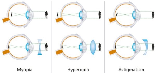 refractive errors