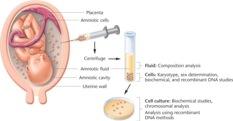 amniocentesis