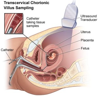 chorionic villus sampling