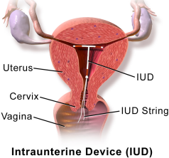 IUD