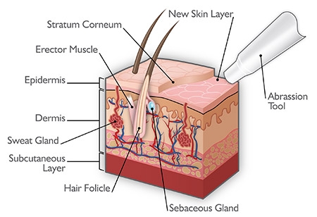 how microdermabrasion works