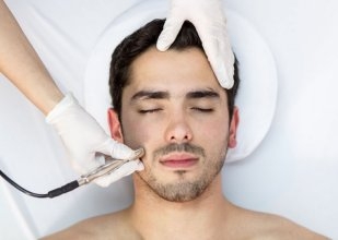 microdermabrasion patient