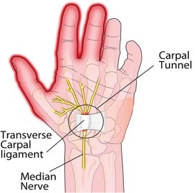 carpal tunnel syndrome