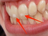 white spots teeth