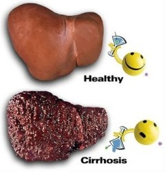 cirrhosis