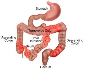 crohns disease