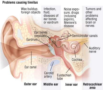 tinnitus cause