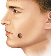 face with birthmark