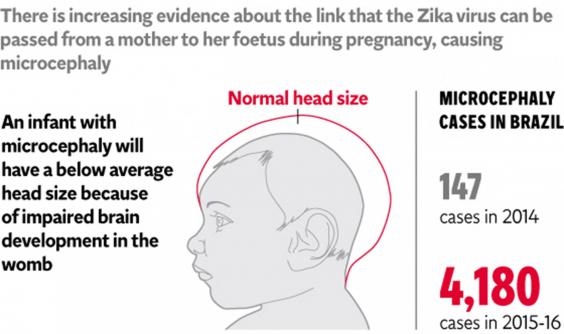 microcephaly